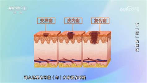 身上有很多痣|痣